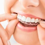 Nakładki Invisalign Lublin