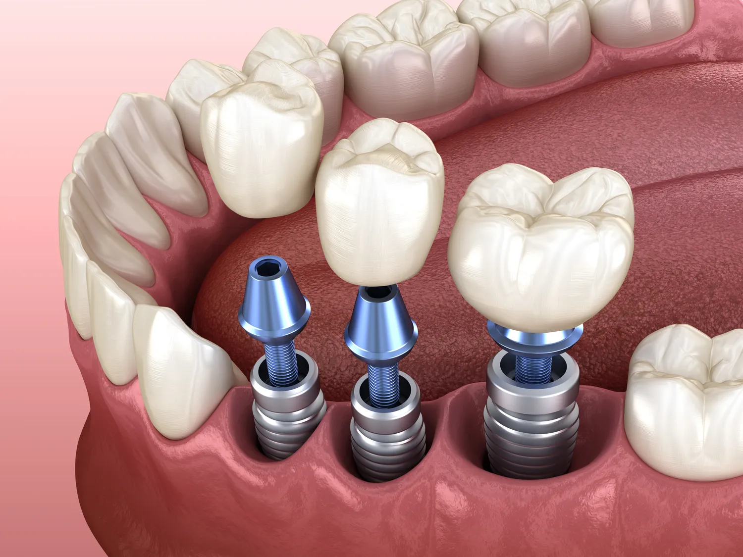 Co to są implanty zębów